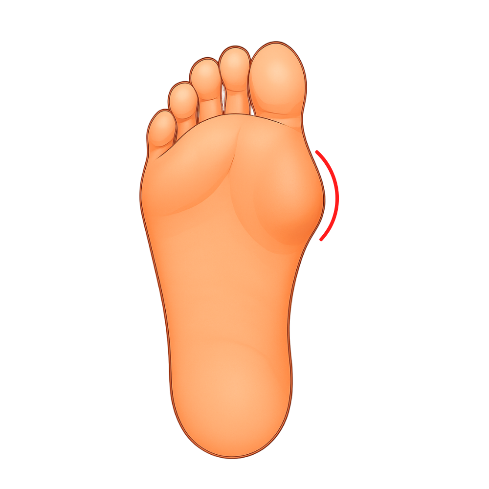Bunion